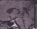 Adenome hypophyse esp