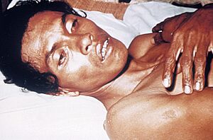 Archivo:Adult cholera patient