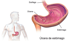 Archivo:Gastric Ulcer esp