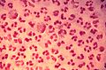 Gonococcal urethritis PHIL 4085 lores