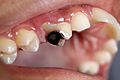 Dental Caries Cavity 2