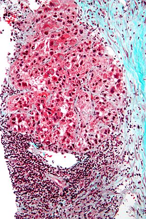 Archivo:Hepatocellular carcinoma intermed mag