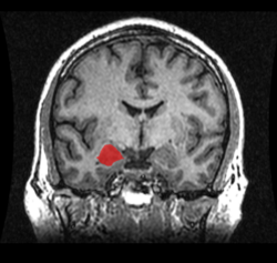 Archivo:MRI Location Amygdala up