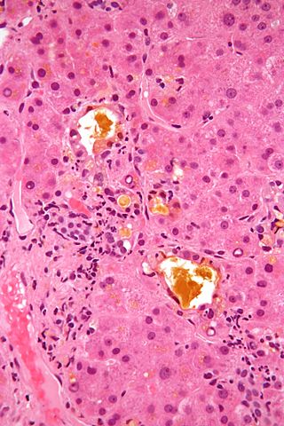 Cholestasis 2 high mag.jpg