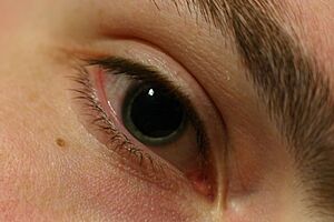 Archivo:Dilated pupil.gk