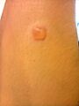 Acute serous inflammation