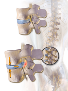 Archivo:Herniated Disc