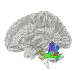 Archivo:Middle Cerebellar Peduncle