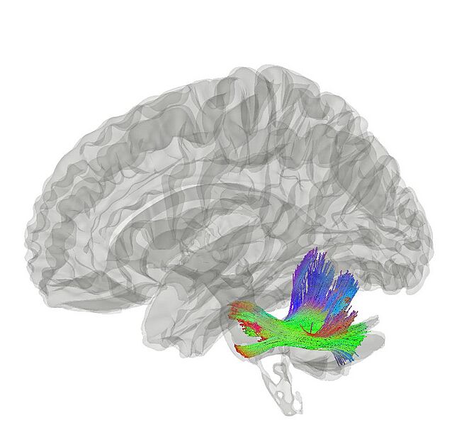 Middle Cerebellar Peduncle