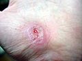 Hand Abrasion - 17 days 11 hours 30 minutes after injury