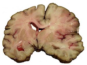 Archivo:MCA-Stroke-Brain-Human-2
