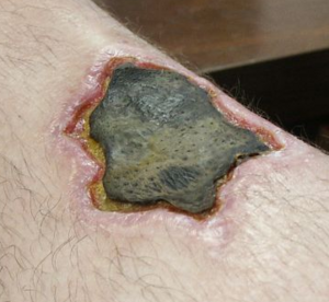 Archivo:Necrotic leg wound