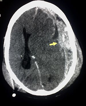 Archivo:Trauma subdural arrow