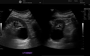 Archivo:Renal cyst ultrasound 2