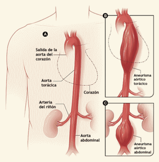 Aortic aneurysm-es.png