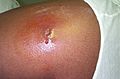 Cutaneous abscess MRSA staphylococcus aureus 7826 lores