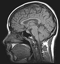 Archivo:MRI brain