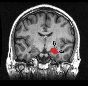Archivo:MRI Location Hippocampus up.