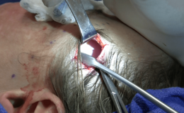 Archivo:Mid facelift (rhytidectomy) upper incision