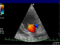 Doppler mitral valve
