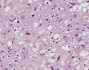 Archivo:Variant Creutzfeldt-Jakob disease (vCJD), H&E