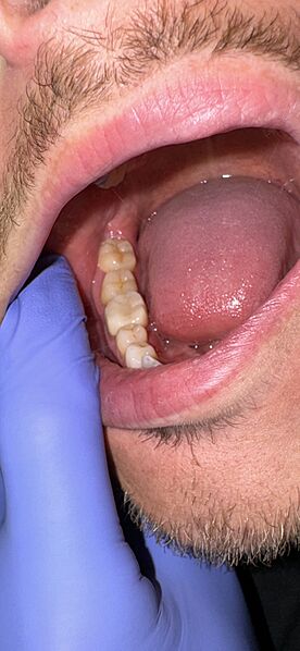 Wisdom teeth 12