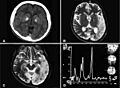 A computed tomography brain scan showing bilateral basal ganglia calcification