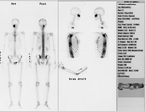 Archivo:Scintigraphie osseuse