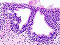 Cystitis glandularis at trigone