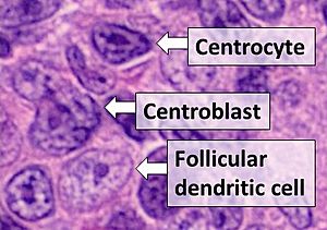 Archivo:Centrocyte, centroblast and follicular dendritic cell in a follicular lymphoma