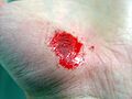 Hand Abrasion - 32 minutes after injury