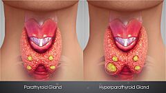 Archivo:3D Medical Animation still shot Hyperparathyroidism