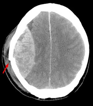 Archivo:Epidurales Haematom