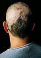 Trichotillomania 1
