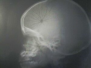 Archivo:StaticElectricityRadiographycFilm