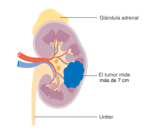 Diagram showing stage 2 kidney cancer CRUK 209-es