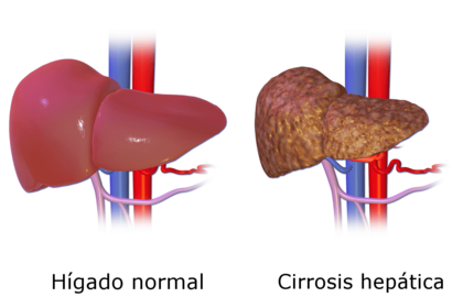 Archivo:Liver Cirrhosis es