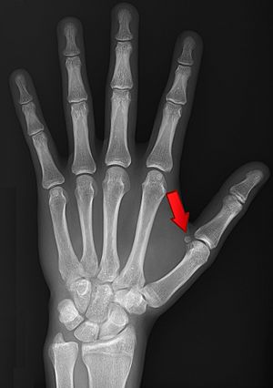 Archivo:X-ray of normal hand by dorsoplantar projection 1