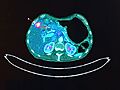 PET región abdominal con metástasis