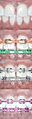Braces Close Diastema Spaces