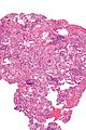 Lung transplant rejection - intermed mag