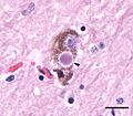 Lewy body in the substantia nigra from a person with Parkinson's disease