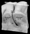 Pre- and post-central gyrus, right hemisphere cropped