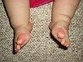 Pieds bot varus équin, en cours de correction