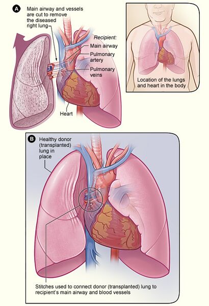 Lung transplant
