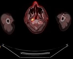 Archivo:PET-CT scan of nasopharyngeal cancer