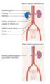 Diagram showing before and after a radical nephrectomy CRUK 104