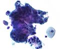 Adenocarcinoma on pap test 1