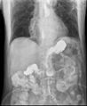Gastroesophageal reflux barium X-ray