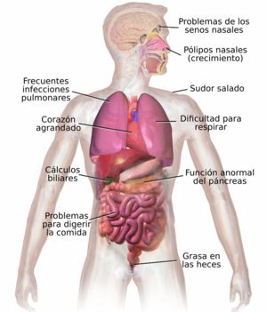 Archivo:Blausen 0286 CysticFibrosis - es